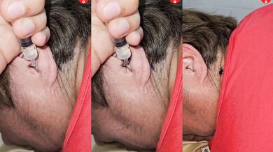 Zbavení se nechtěného návštěvníka v uchu