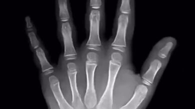 18 let rentgenových snímků ruky